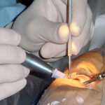 Cataract_surgery