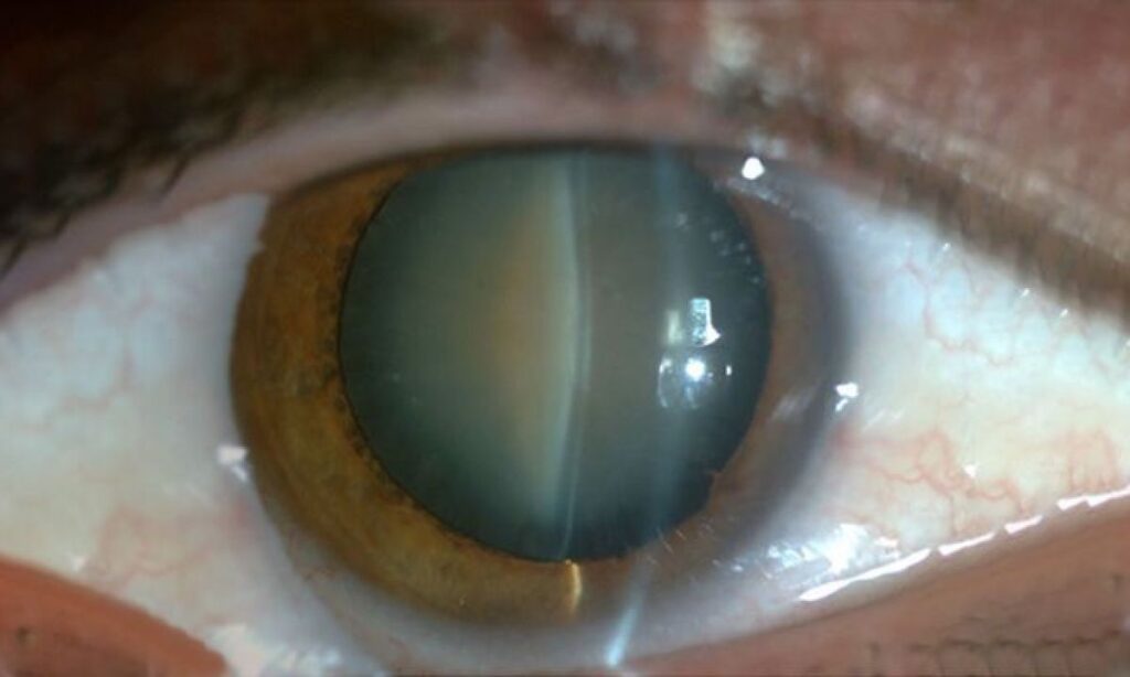 cataract surgery