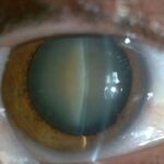 cataract surgery