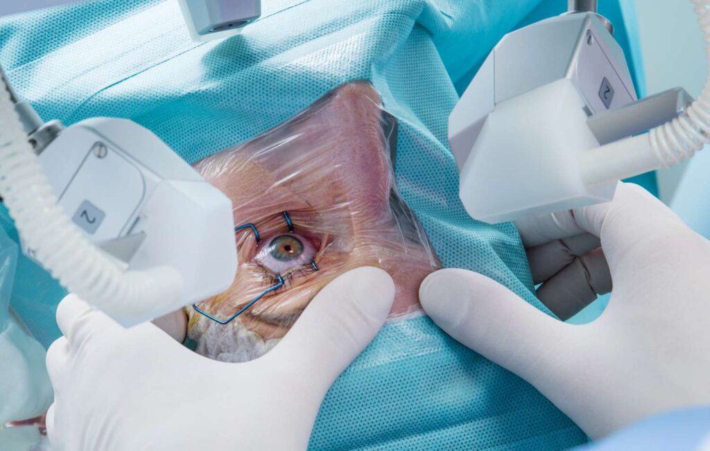 cataract surgery